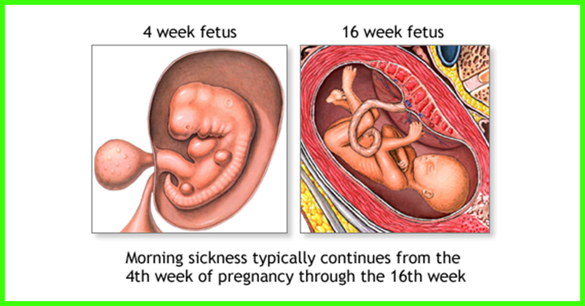 Featured image of post How To Handle Vomiting During Pregnancy